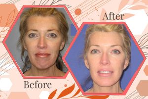 face-lift-before-after