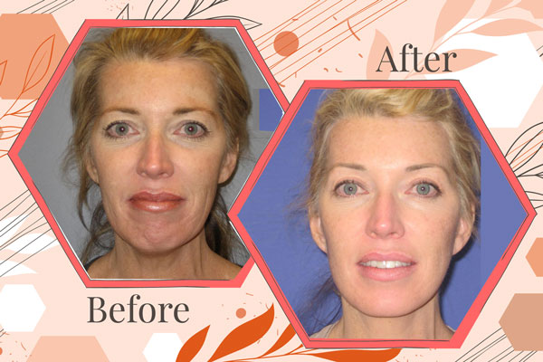 face-lift-before-after