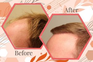 hair-transplant-before-after
